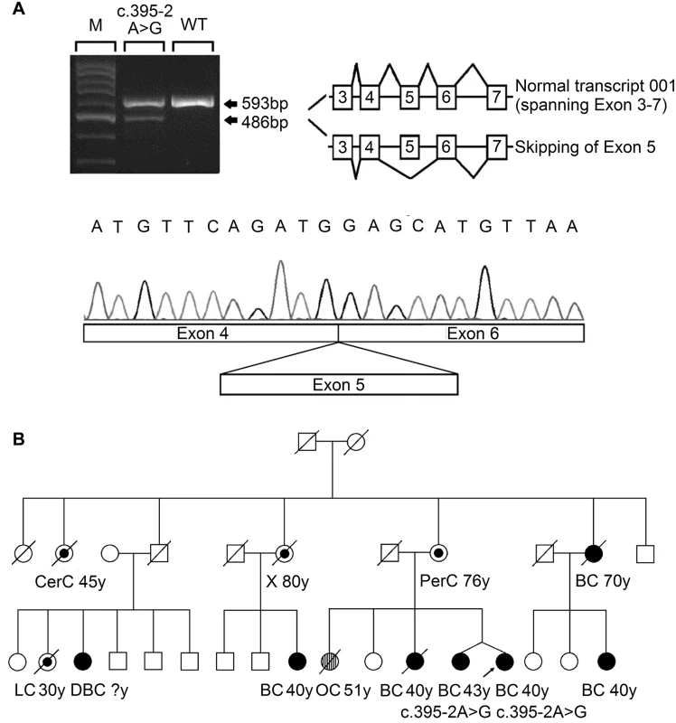 Analysis of the splicing mutation 395–2 A>G.