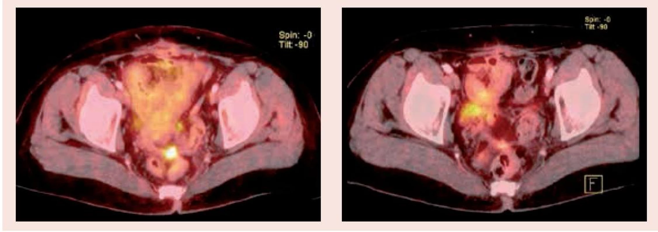 PET/CT vyšetření před zahájením léčby (2.1) a po 3 měsících (2.2) – oblast malé pánve