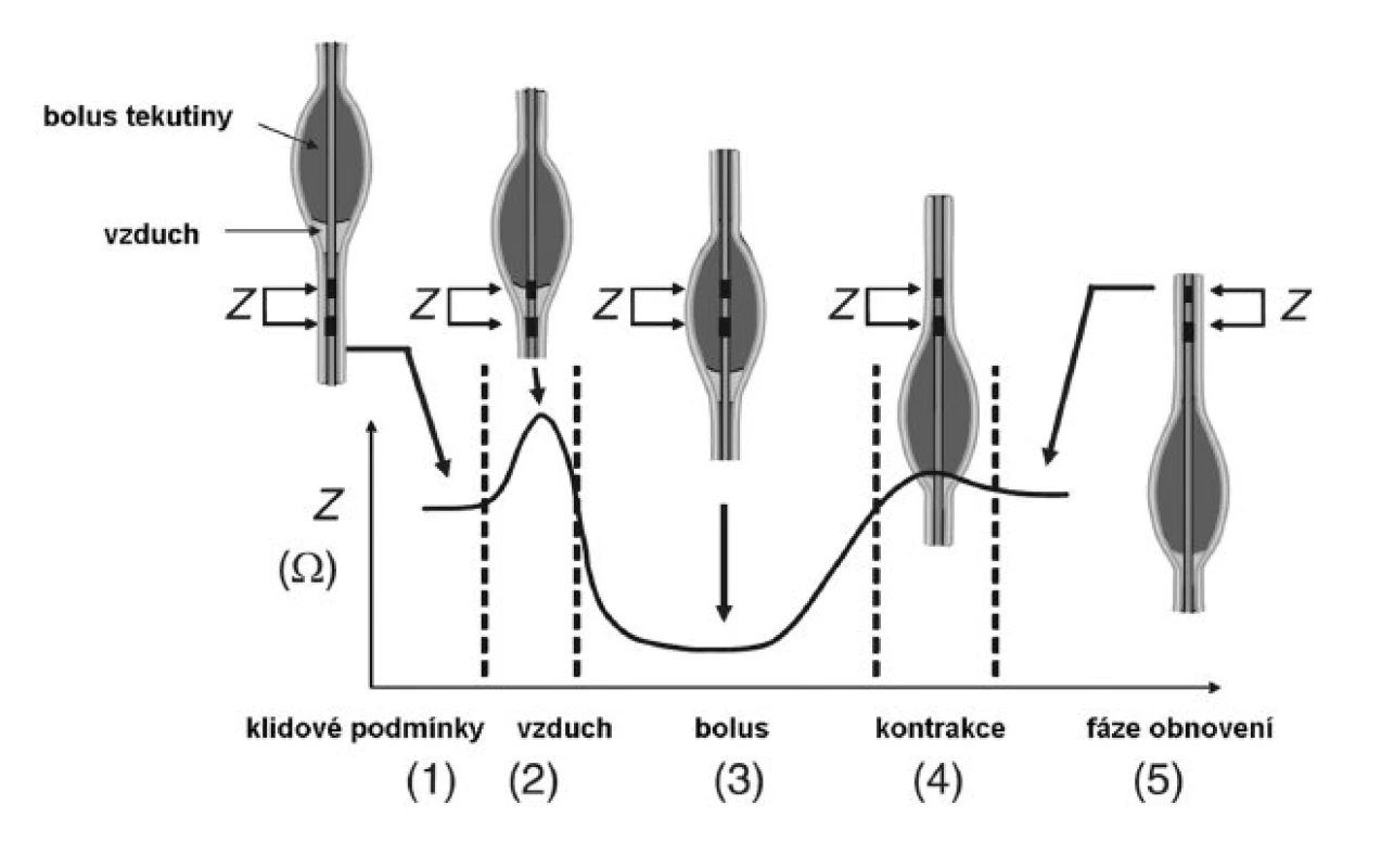Změna impedance jícnu v průběhu přechodu bolusu jícnem. Při přechodu bolusu jícnem dochází k typické změně impedance mezi 2 sousedními senzory, která pozůstává z 5 stadií:<br>1. Základní hladina impedance v klidu.<br>2. Impedance roste při přechodu vzduchu (který předchází bolus) jícnem.<br>3. V průběhu pasáže bolusu místem senzorů impedance klesá.<br>4. Impedance roste z důvodu kontrakce svaloviny jícnu.<br>5. Impedance se vrací do původních klidových hodnot (upraveno podle Conchillo et al, 2008)