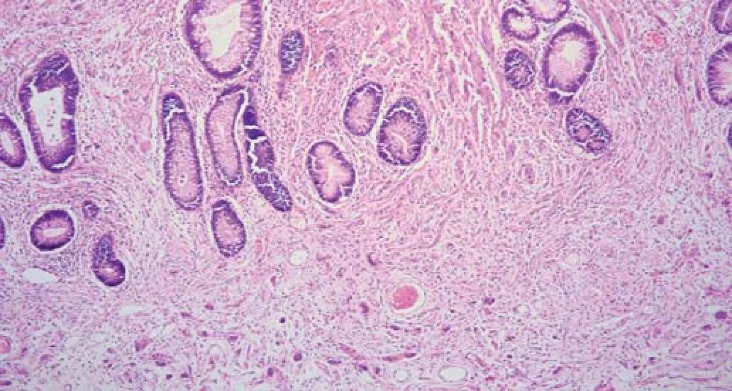 Histologický nález odstraněného malého polypu, barvení hematoxylin a eozin, zvětšeno 100×.