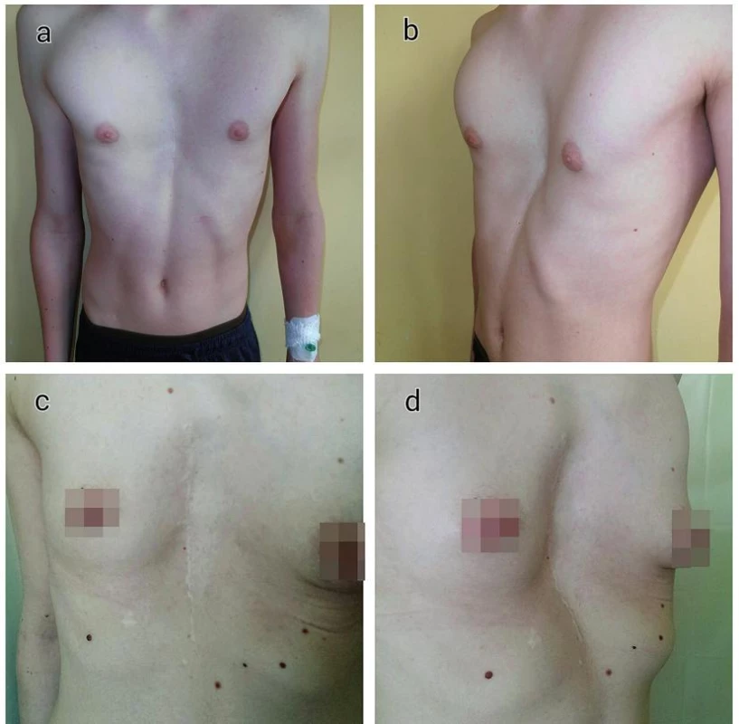 Pacienti s recidivujúcim pectus excavatum po modifikovanej Ravitchovej korekcii
a−b) 17ročný pacient
c−d) 27ročná pacientka
Fig. 1. Patients with recurrent pectus excavatum after Highly Modified Ravitch Repair
a−b) 17-year-old male
c−d) 27-year-old female