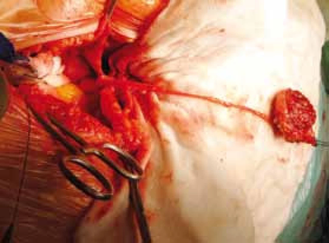 Peroperační nález – preparace urachu
Fig. 3. Intraoperative finding – urachal dissection