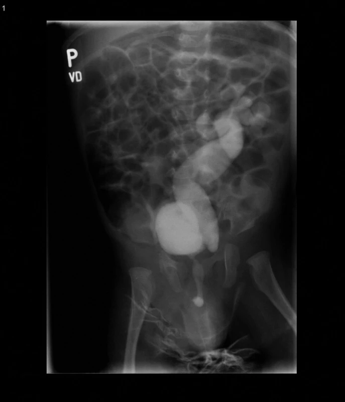 Kazuistika č. 4. Mikční cystografie – vezikoureterální reflux IV. st. vlevo.
Fig. 7. Case report 4. Voiding cystography – vesicoureteral reflux of 4th degree on the left.