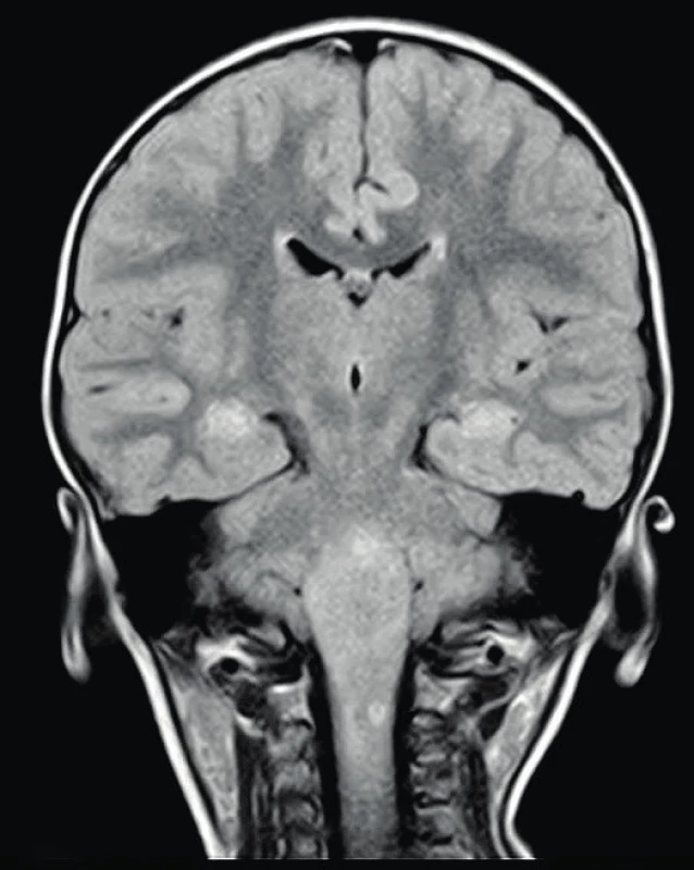 Patologické ložisko v kaudální části pontu, T2, FLAIR 
Fig. 3. Patologic bearing in caudal portion of pont, T2, FLAIR