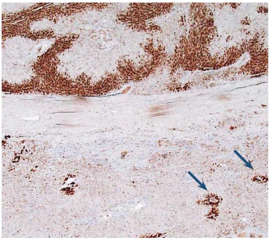 Imunohistochemický průkaz glutamin syntetázy (GS). Dole normální detekce v hepatocytech centrolobulárně (šipky). Nahoře plošně pozitivní průkaz v adenomu.
Fig. 8. Immunohistochemical detection of glutamine synthetase (GS). At the bottom of image is normal detection in centrolobular hepatocytes (arrows). At the top of image GS is diffusely expressed.