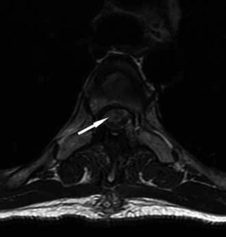 MR T2 axiální sken v úrovni reponované herniace míchy (pooperační stav, tři měsíce od operace), šipka ukazuje hypersignální ložisko odpovídající původně herniované, glioticky změněné části míchy.