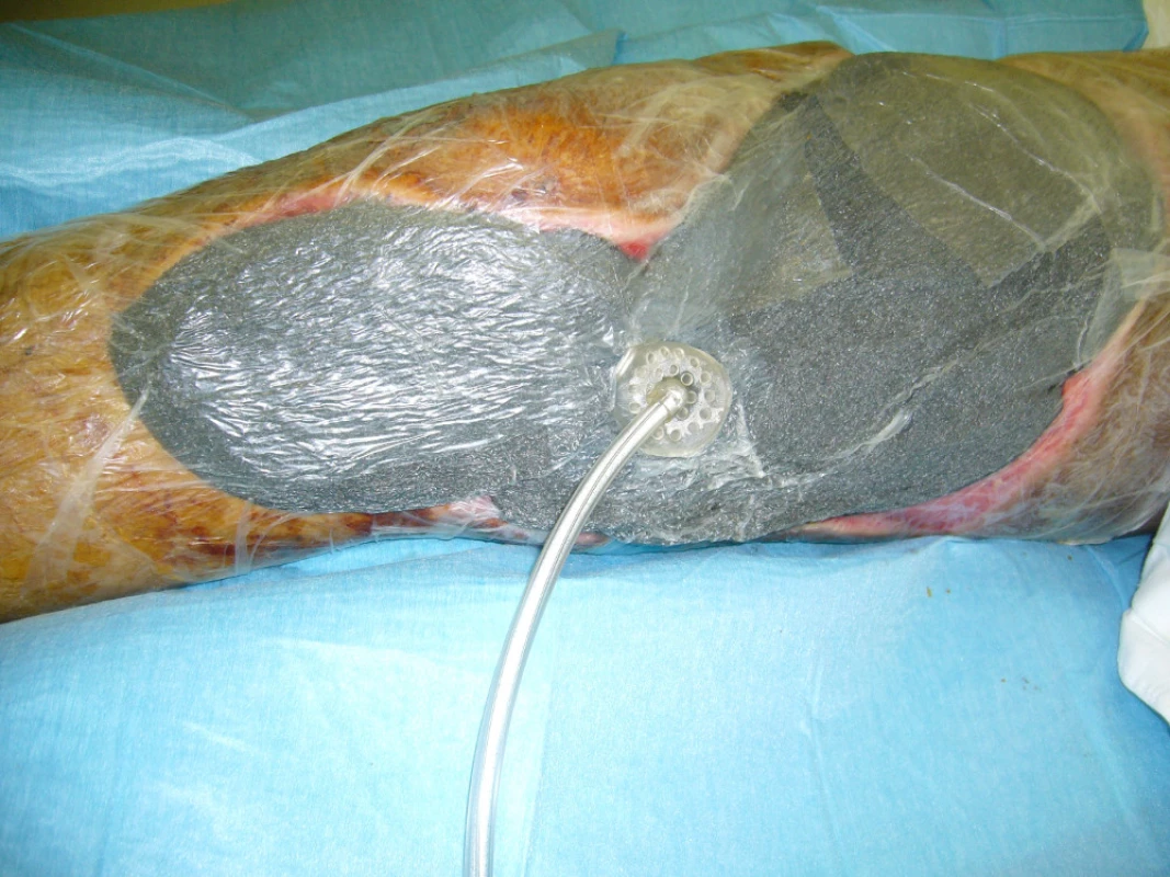 Aplikace VAC systému po ukončení léčby v hyperbarické komoře