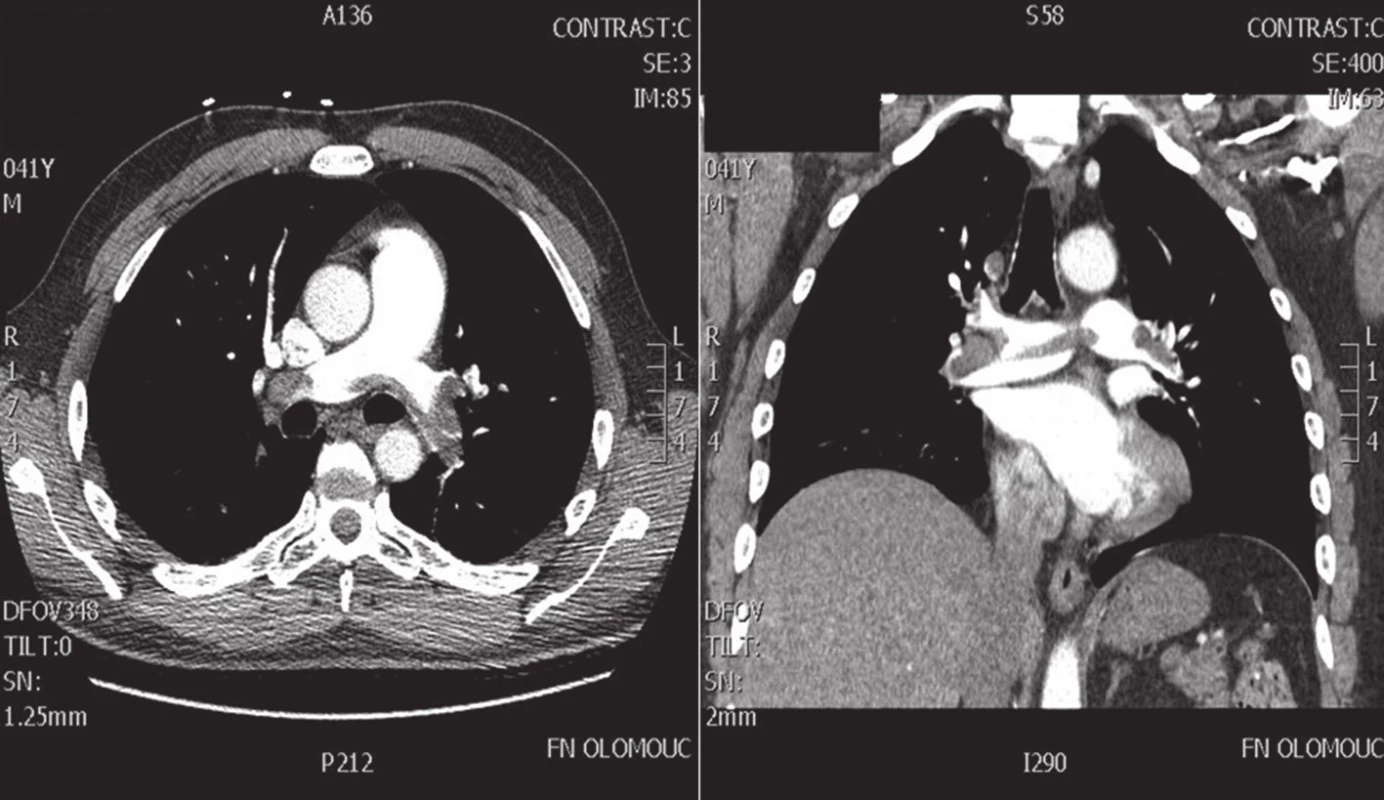 CT angiografie paracentrální formy plicní embolizace
Fig. 2. CT angiography of centrally located pulmonary embolism