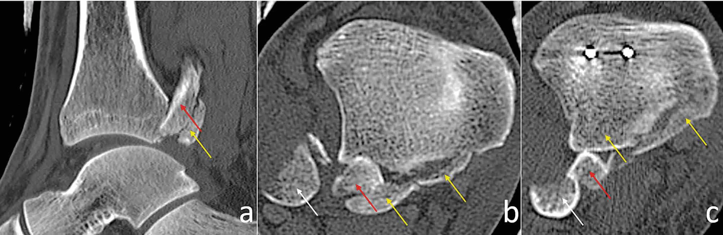 Varianty dislokace proximálního úlomku fibuly u Bosworthovy zlomeniny </br> Variants of displacement of the proximal fragment of the fibula in Bosworth fracture