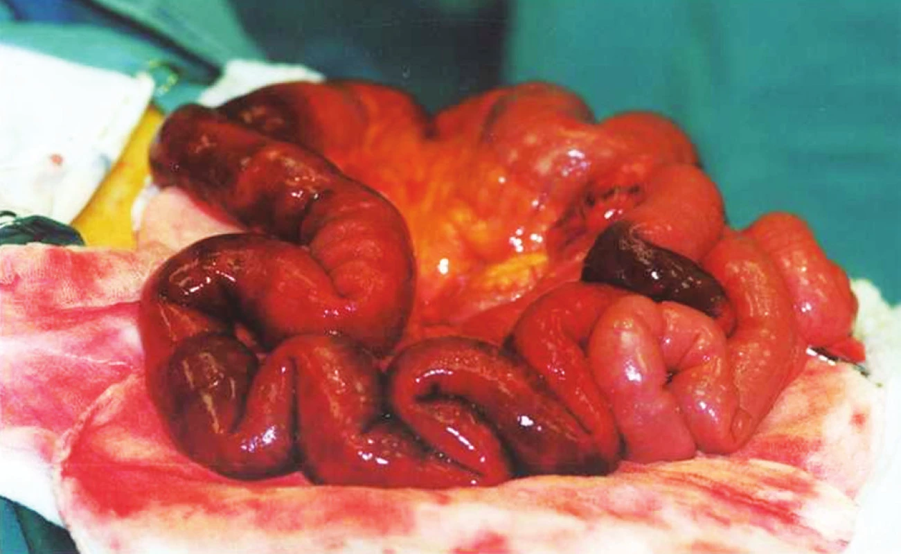 Krvácení do stěny střevní a závěsu při předávkování
warfarinem
Fig. 4. Intestinal wall and peritoneal bleeding due to warfarin
overdose