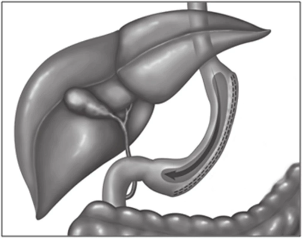 Sleeve gastrectomy − tubulizace žaludku
Fig. 1: Sleeve gastrectomy