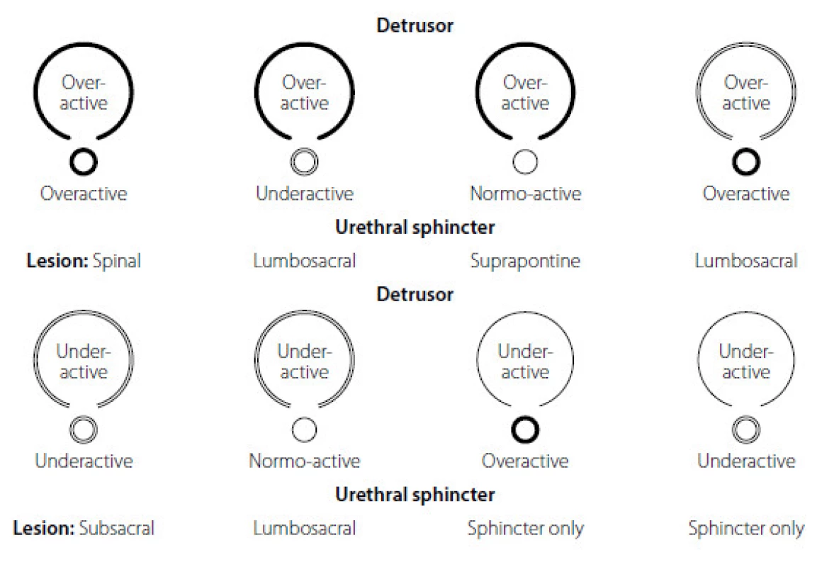 Madersbacherova klasifikace neurogenní dysfunkce dolních cest močových v závislosti od úrovně léze CNS, převzato z www.uroweb.org (13, 14)
Fig. 2. The EAU – Madersbacher classification systém of neurogenic lower urinary tract dysfunction from www.uroweb.org (13, 14)