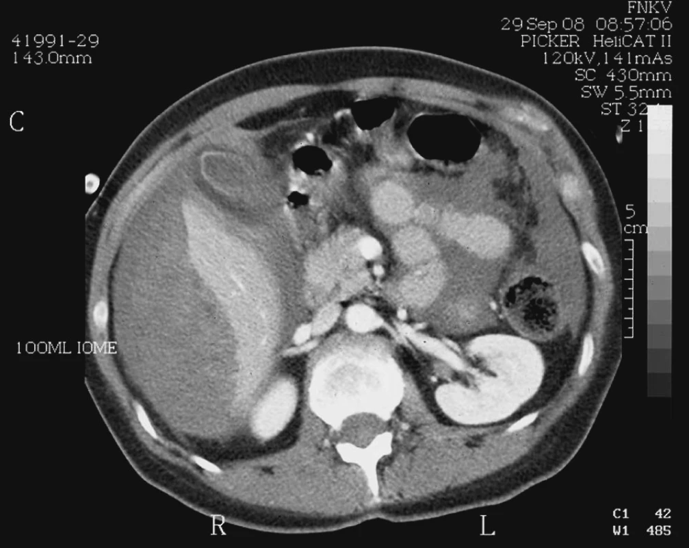 Perforace subkapsulárního hematomu jater při předávkování
warfarinem
Fig. 5. Perforation of subcapsular liver hematoma, warfarin
overdose