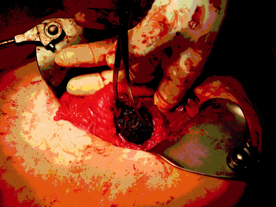Odstraňování konkrementu z duodenotomie. Cholecystektomie je již provedená
Fig. 8. The concrement removal via duodenotomy. Cholecystectomy has already been performed