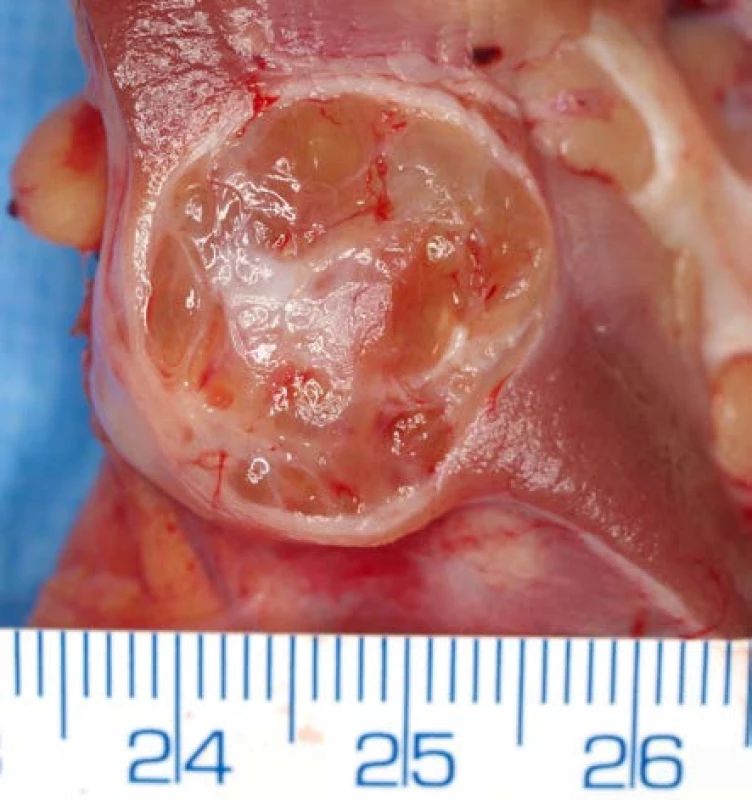 <i>Světlobuněčný renální karcinom – multicysticky změněný</i>
Fig. 1. <i>Clear cell renal cell carcinoma – multicystically changed</i>