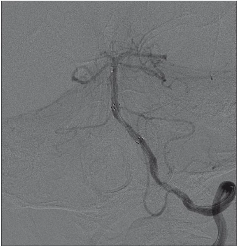 Výsledek po provedení angioplastiky proximální bazilární tepny s implantací stentu (Wingspan 3,5 × 15) a 35 minutách insonace a aplikace rt- PA systémem Eko-Sonic SV<sup>TM</sup>.