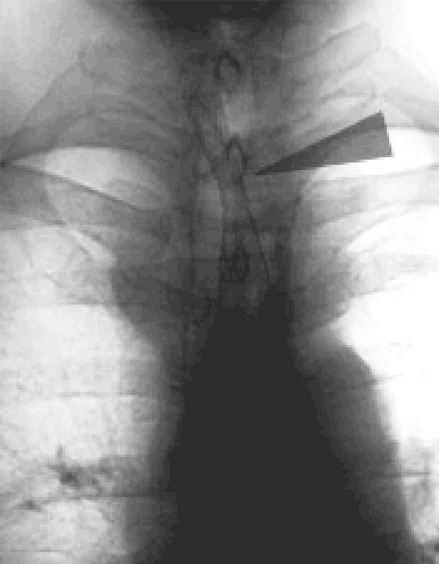 RTG obraz stenózy jícnu ošetřené stentem ELLA
Fig. 5. X-ray view of esophageal stenosis managed with an ELLA stent 