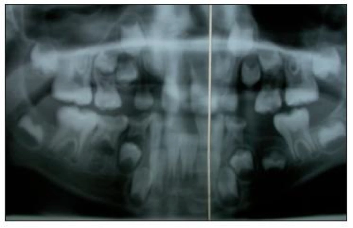 Ortopantomogram po extrakci radixu 64.
