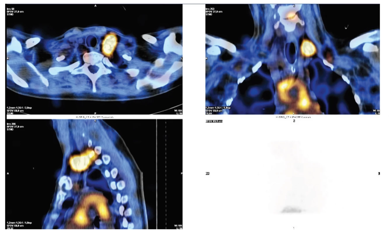 Lymfoscintigrafie u poranění ductus thoracicus v krční oblasti vlevo po revizi při těžké krční fasciitidě<br>
Fig. 3. Lymphoscintigraphy in injuries of the thoracic duct in the left neck area after a revision in severe cervical fasciitis