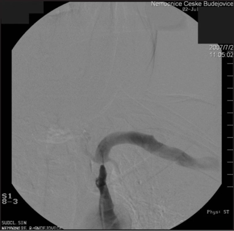 Angiografie: stenóza a. subclavia