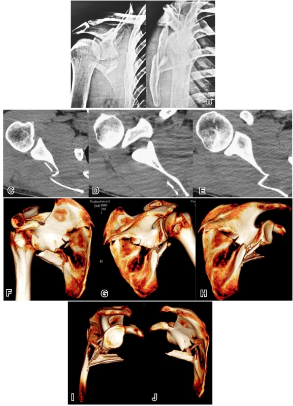 Kompletní radiologické vyšetření u pacienta se dvoufragmentovou zlomeninou těla: A – Neerova I. projekce, B – Neerova II. projekce, C, D, E – příčné CT řezy v proximodistálním pořadí, F – 3D CT rekonstruce, pohled zpředu, G – 3D CT, pohled zezadu, H – 3D CT, pohled zezadu se subtrakcí proximálního humeru, I – 3D CT, pohled z laterální strany se subtrakcí proximálního humeru a klíčku, J – 3D CT, pohled z mediální strany se subtrakcí proximálního humeru a klíčku. Srovnání jednotlivých metod ukazuje, jak zavádějící jsou CT řezy při diagnostice zlomenin těla lopatky. Peroperační nález u tohoto pacienta přesně odpovídal 3D CT rekonstrukci. 
Fig. 3. Complete radiological image in patient with transverse fracture of the scapula body: A – Neer I view, B – Neer II view, C, D, E CT – scans in proximo-distal sequence, F – 3D CT reconstruction, anterior view, G – 3D CT reconstruction, posterior view, H – 3D CT reconstruction, posterior view with subtraction of proximal humerus, I – 3D CT reconstruction, lateral view with subtraction of proximal humerus and clavicle, J – 3D CT reconstruction, medial view with subtraction of proximal humerus and clavicle. Comparison of individual methods shows how misleading the transverse CT scans may be for diagnostics of fracture of scapula body. Intraoperative finding view in this patient corresponded exactly to 3D CT reconstruction.