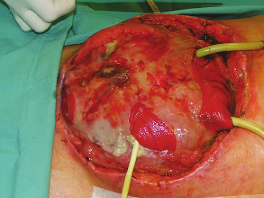 Mnohočetné píštěle z tenkého střeva v rozsáhlém abdominálním defektu (pacient č. 9)
Fig. 1. Multiple small intestinal fistulas in an extensive abdominal defect (patient No 9)
