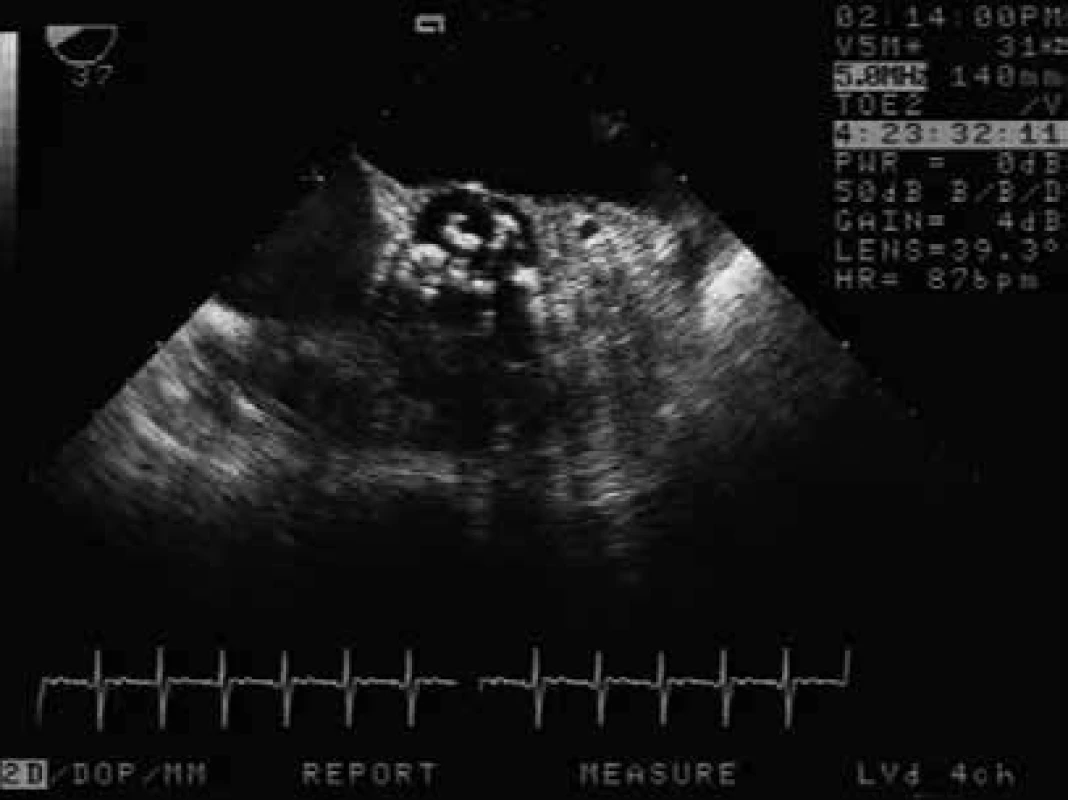 Vyšetření TEE pacientky resuscitované pro
arytmii, příjmové vyšetření odhalilo těsnou
aortální stenózu (AVAi 0,4 cm2). Vyšetření TEE
ze středního jícnu – nahoře levá síň, v centru
těžce degenerovaná aortální chlopeň, která
byla 2. den po příjmu nahrazena protézou