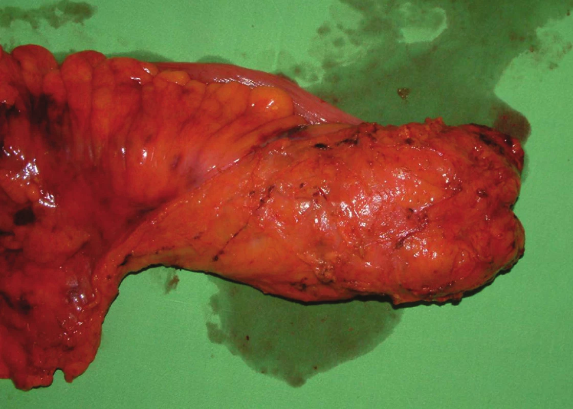 Makroskopický preparát rekta s kvalitnou TME (M.E.R.C.U.R.Y. I°)
Fig. 4: Macroscopic specimen of the rectum with high-quality TME (M.E.R.C.U.R.Y. I°)