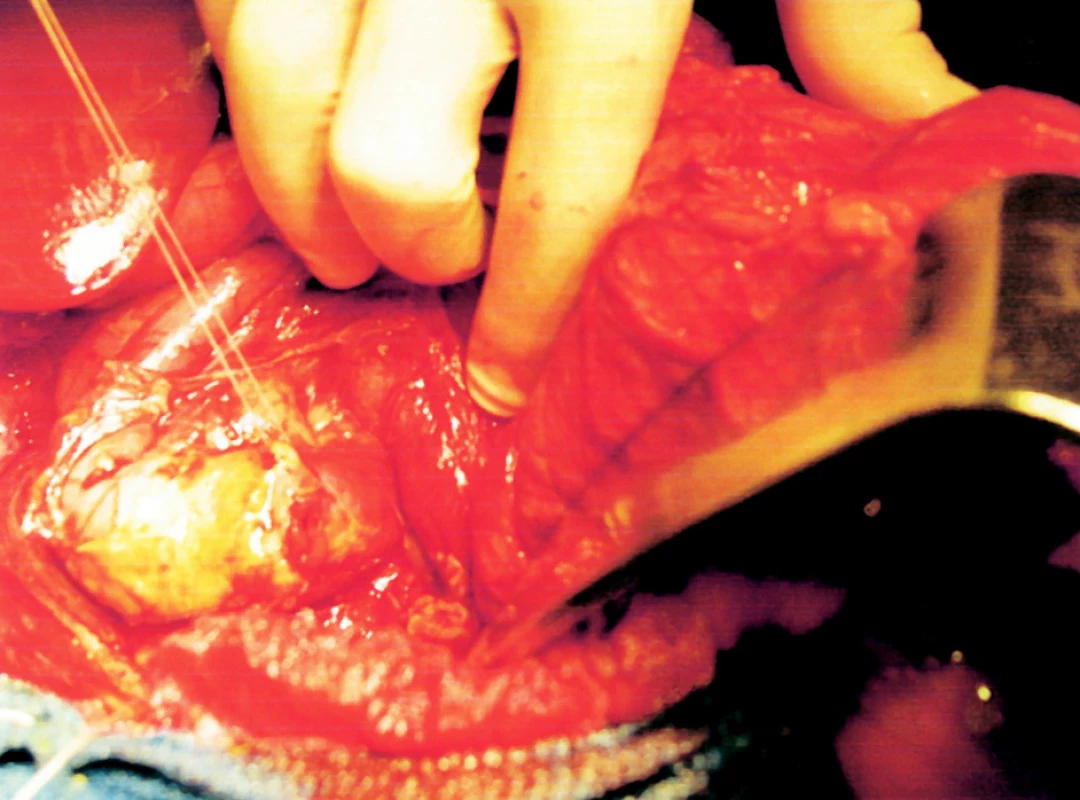 Peroperační fotografie s perforačním otvorem na zadní stěně duodena na hranici D2-D3
Fig. 5. Intraoperative view depicting a perforation opening in the posterior duodenal wall at the D2-D3 line