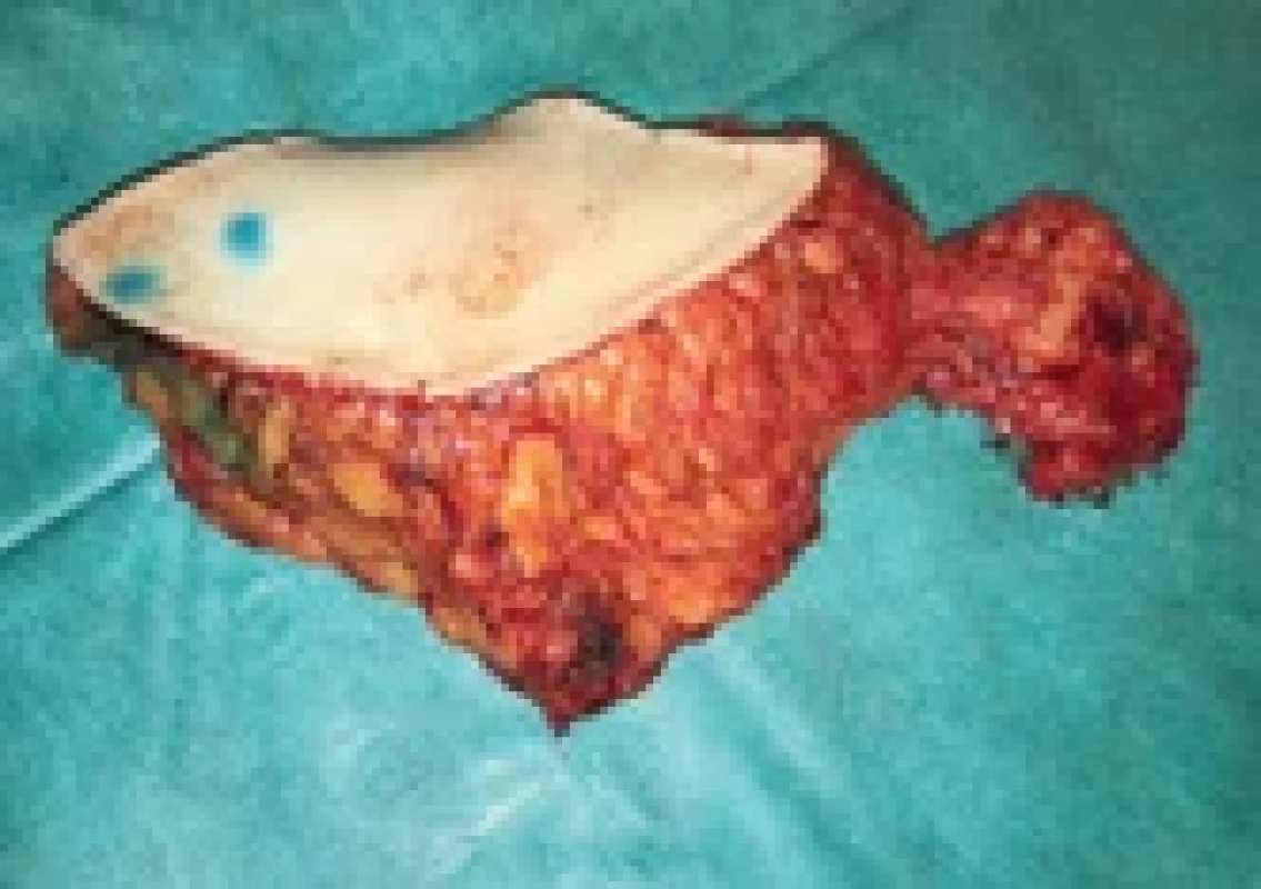 Harvested vascularized lymph nodes fl ap.