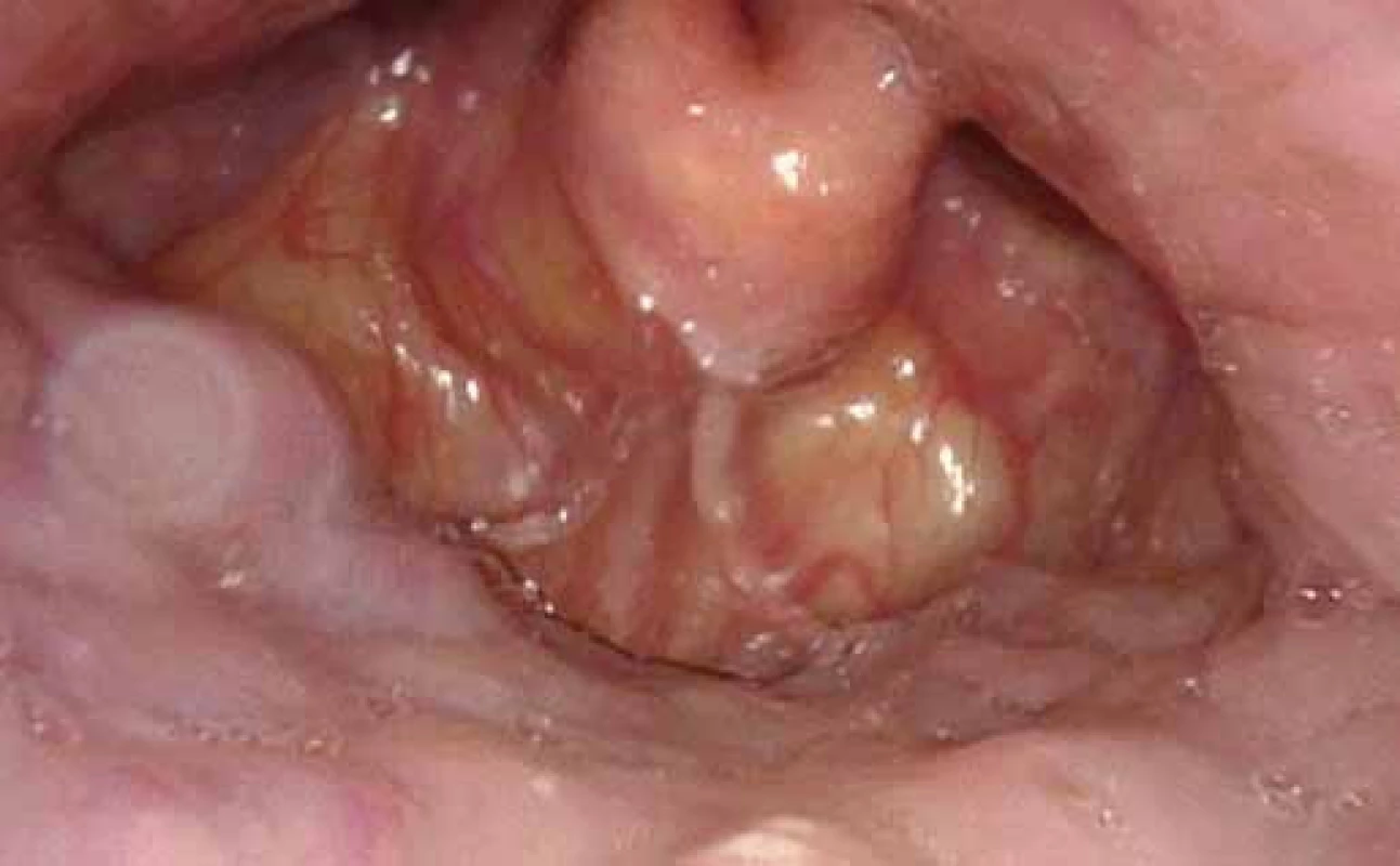 DISE – obstrukce způsobená laterálním kolapsem ztluštělé epiglotis.
Fig. 4. DISE – obstruction caused by lateral collapse of thickened epiglottis.