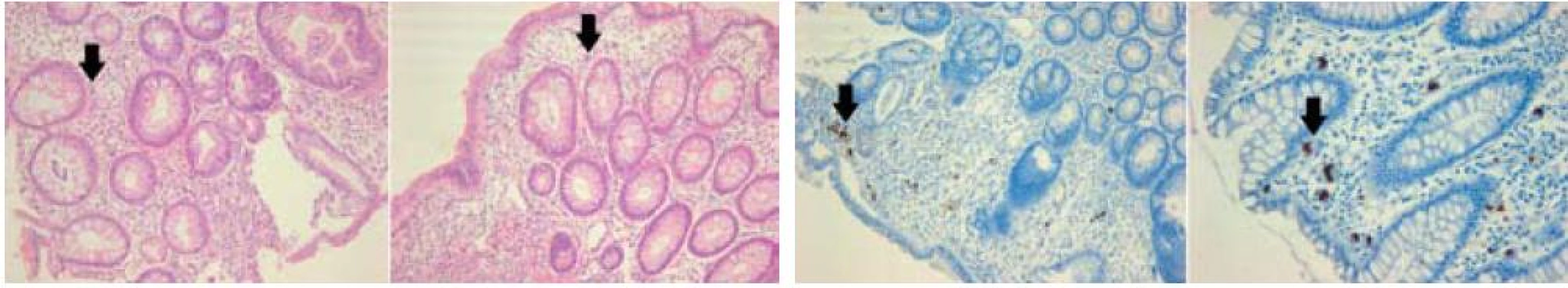 Histologický obraz CMV kolitidy: vlevo – v barvení hematoxylin-eosinem, vpravo – imunohistochemický průkaz CMV (immediate early antigen CMV). Šipky označují typické „megalocyty“ s inkluzemi.
Fig. 1. Histological depiction of CMV colitis: left – coloured haematoxylin-eosin, right – immunohistochemical CMV mark (immediate early antigen CMV). Arrows indicate typical ‘megalocytes’ with inclusions.
