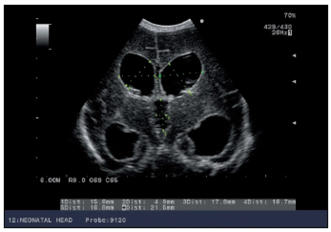 USG morfometria mozgových komôr u novorodenca s progresívnym hydrocefalom – koronárny rez.
Fig. 1. USG morphometry of brain chambers in a newborn with progressive hydrocephalus – coronary section.
