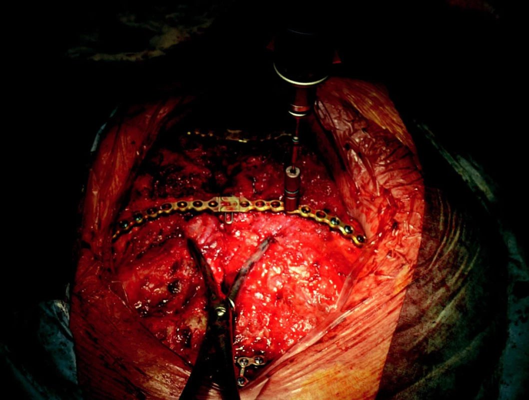 Implantace dlah – předvrtání otvorů