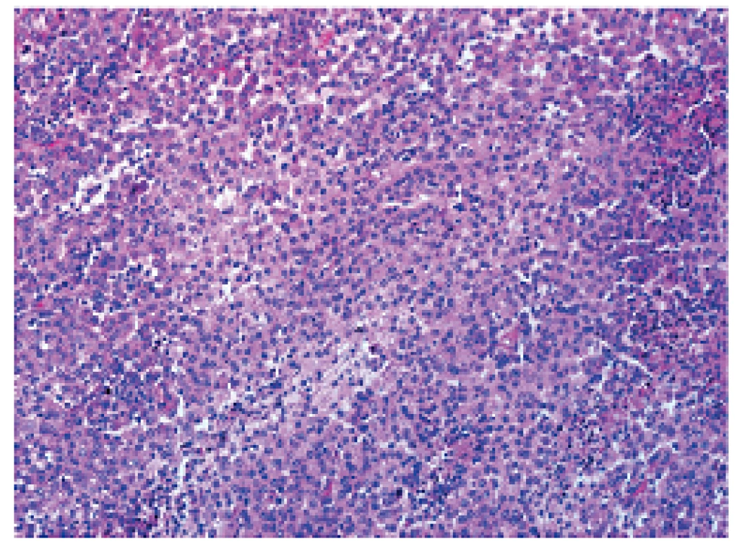 Peroperační nález
Fig. 3: Intraoperative findings