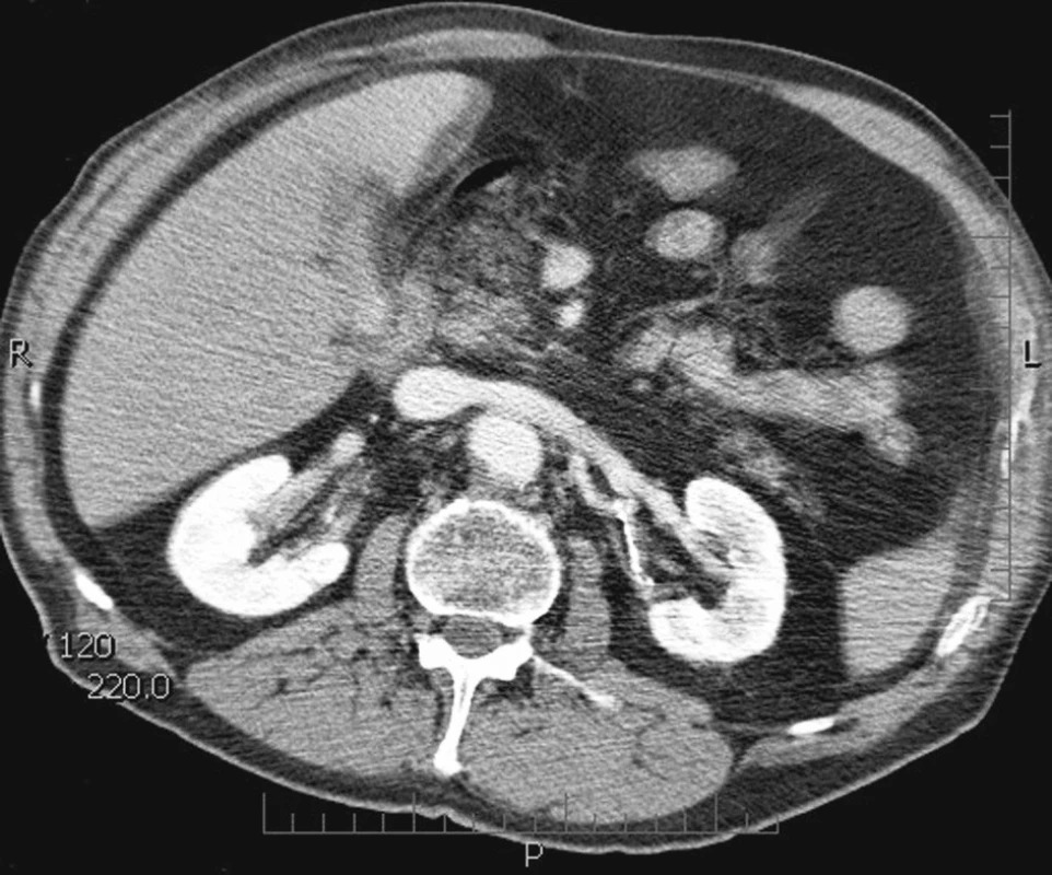 CTA obraz přetlaku v renálním žilním řečišti.
Fig. 2. A CTA view of the renal venous bloodstream overpressure.