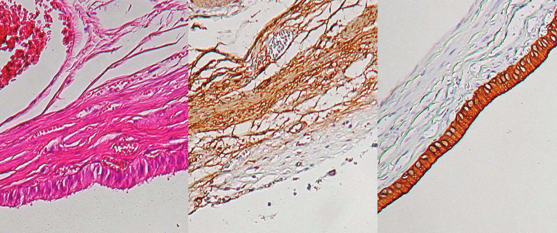 Histologický nález – žlčník, zľava normálne farbenie, v strede svalovina znázornená protilátkami proti aktínu,
vpravo epitel žlčových ciest znázornený protilátkami proti cytokeratínu C19
Fig. 7. Histological preparation – gall-bladder: normal staining on the left, muscle layer stained with monoclonal antibodies
against actin in the middle, biliary epithelium stained with antibodies against cytokeratin C19 on the right