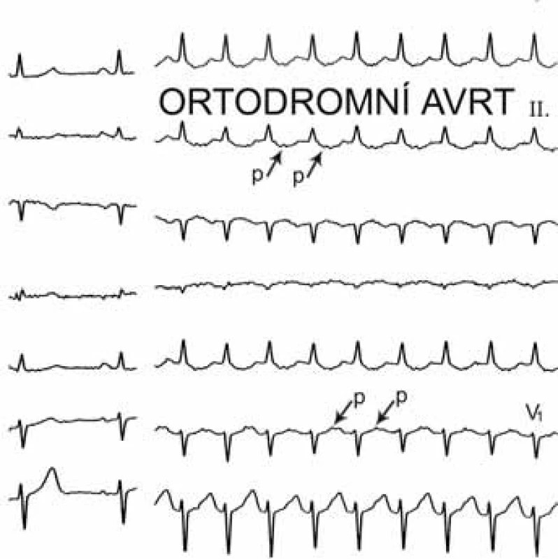 Atrioventrikulární reentry tachykardie (AVRT) – ortodromní forma. Posledních 9 QRS-komplexů je následováno P-vlnami (označené šipkami), které jsou 160 ms za počátkem QRS-komplexu, nicméně leží v 1. polovině RR-intervalu a jde tedy o tachykardii s krátkým RP-intervalem. Vzdálenost P-vln více jak 90 ms od začátku QRS-komplexu odlišuje tuto arytmii od typické AV nodální reentry tachykardie.