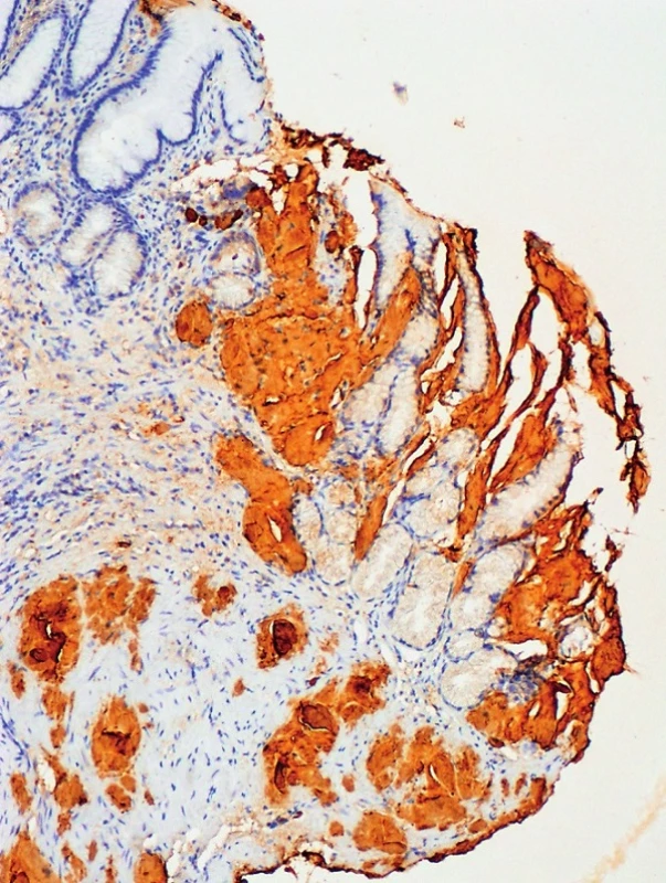 Imunohistochemie – transthyretin, zvětšení 100x
Pozitivita amyloidových depozit v lamina propria a navazující lamina muscularis mucosae žaludeční stěny
(Poskytnuto MUDr. Pavlou Látalovou, Ústav klinické a molekulární patologie, Fakultní nemocnice Olomouc.)