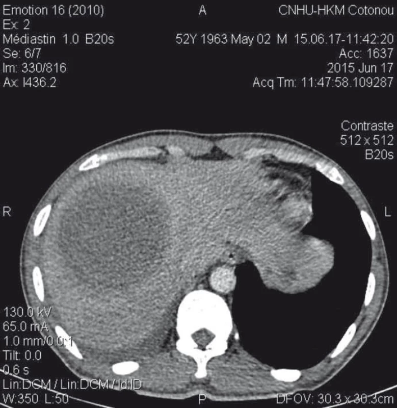 Abdominal CT scan showing a thick-walled and enhanced mass-collected mass after injection of contrast medium, surrounded by a hypodense crown (dual target appearance) in segments VII and VIII of the liver.<br>
Obr. 1. Abdominální CT zobrazující silnostěnné koncentrované ložisko v játrech po
vstříknutí kontrastního média, obklopené hypodenzním ložiskem (duální zaměření)
v segmentech VII a VIII.