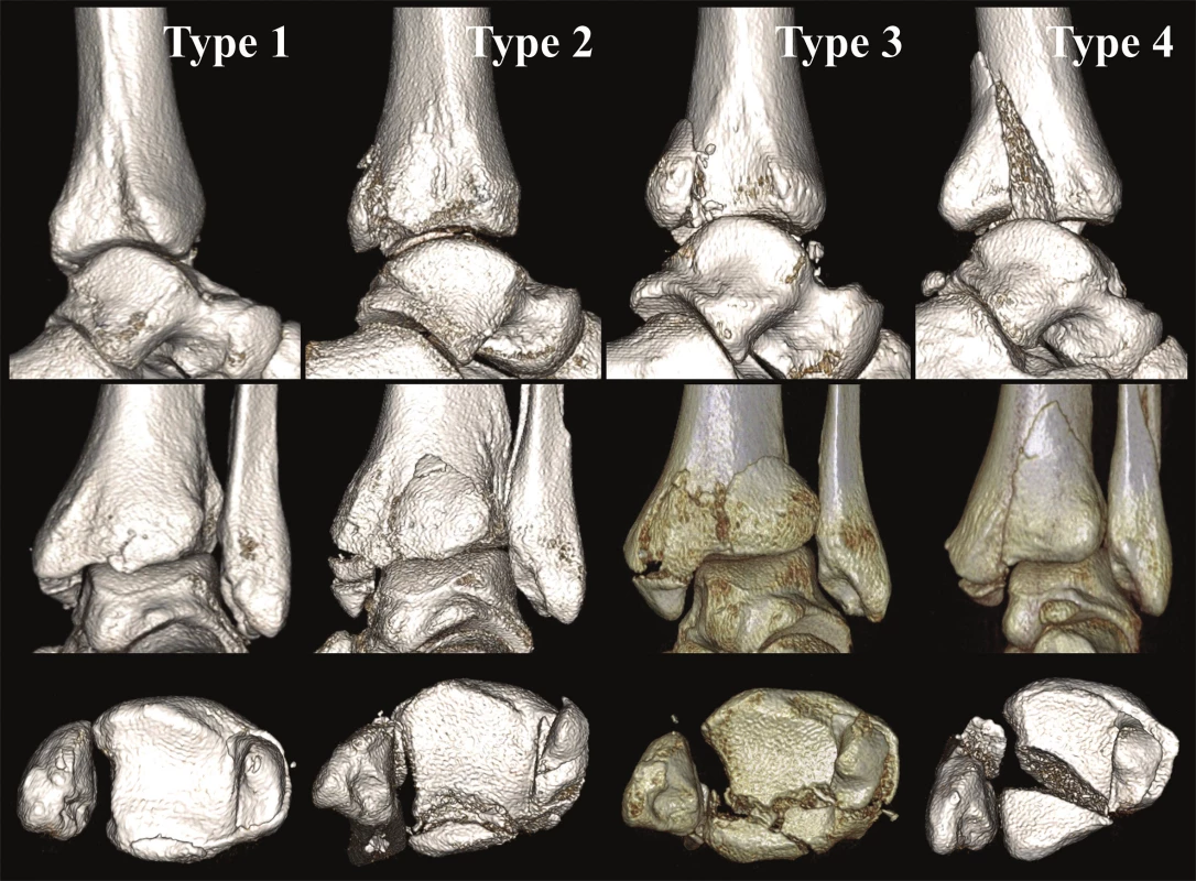 Anatomická 3D CT klasifikace z r. 2015 [34]
Jednotlivé typy z Obr. 6 na 3D CT rekonstrukcích. Typ 1 – extraincisuralní fragment, Typ 2 – posterolaterální fragment, Typ 3 – dvojitý fragment s postižením mediálního kotníku, Typ 4 – velký triangulární fragment. Horní pás ukazuje jednotlivé typy v pohledu z laterální strany po subtrakci fibuly. Je dobře hodnotitelné postižení incisura fibularis tibiae. Ve středním pásu pohled z dorzální strany. Zde je patrný základní tvar fragmentu. V dolním pásu pohled do tibiofibulární vidlice po subtrakci talu. V tomto pohledu lze hodnotit rozsah postižení kloubní plochy distální tibie.
Fig. 10: Anatomical 3D CT classification published in 2015 [34]
Individual types from Fig. 6 on 3D CT reconstructions. Type 1 – extraincisural fragment, Type 2 – posterolateral fragment, Type 3 – two- part fragment with involvement of medial malleolus, Type 4 – large triangular fragment. Figures in the upper row show individual fracture types from the lateral view after subtraction of the fibula, allowing proper assessment of involvement of the incisura fibularis tibiae; the middle row includes figures from the posterior view, showing the basic shape of the fragment; and figures in the lower row show the tibiofibular mortise after subtraction of the talus, allowing assessment of involvement of the articular surface of the distal tibia.