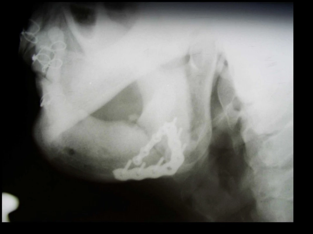 Zlomenina čelistního úhlu, ošetřená rigidní osteosyntézou