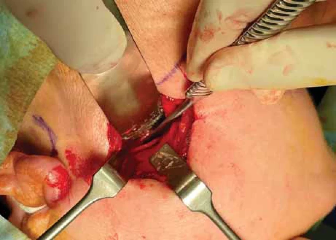 Exposure of the SP from the extraoral approach.
