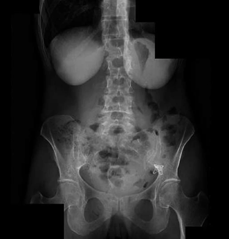 RT G nativ břicha 35. den po perforaci již bez penumoperitonea, OT SC<sup>®</sup> klip in situ.
Fig. 6. Abdominal X-ray, day 35 after perforation, pneumoperitoneum is no longer visible, OTSC<sup>®</sup> in situ.
