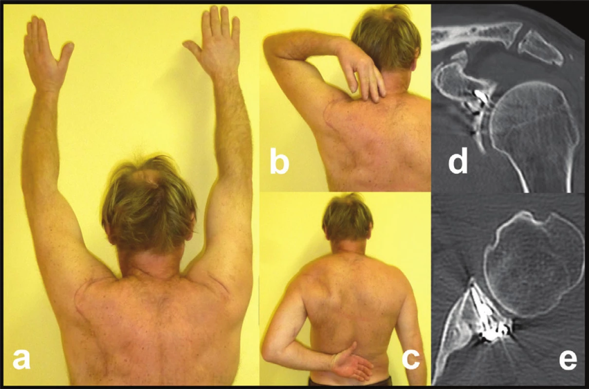 Functional and radiological result (Pt – 9) in fourpart glenoid fossa fracture with separation in the surgical neck, fracture of scapular body and AC dislocation