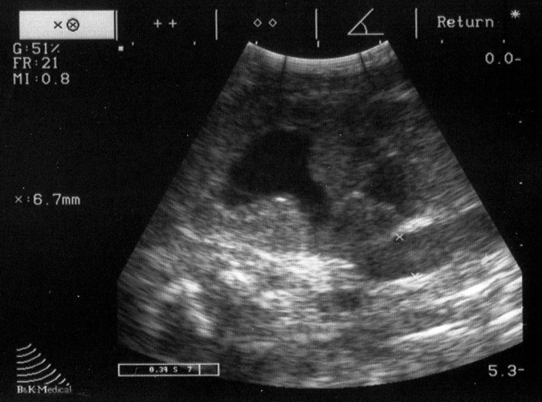 Kazuistika č. 3. UZ levé ledviny: dilatace pánvičky horního segmentu a dilatace proximálního ureteru od horního segmentu na šíři 6,7mm.
Fig. 4. Case report 3. US of the left kidney: dilatation of upper segment of the pelvis and dilatation of proximal ureter from upper segment to the 6.7 mm width.