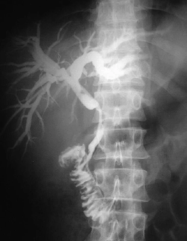Transpapilárna PTD drenáž pri malígnej stenóze choledochu (Bismuth I)
Fig. 3: Transpapillary PTD drainage in malignant stenosis of the bile duct (Bismuth I)