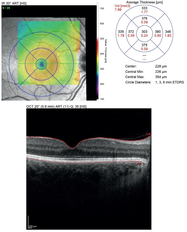 Follow-up OCT scan of the right eye performed two years postpartum. The OCT findings reveal a stable anatomical outcome, with preserved foveal depression. At the time of examination, the patient is in the 30th week of a subsequent pregnancy