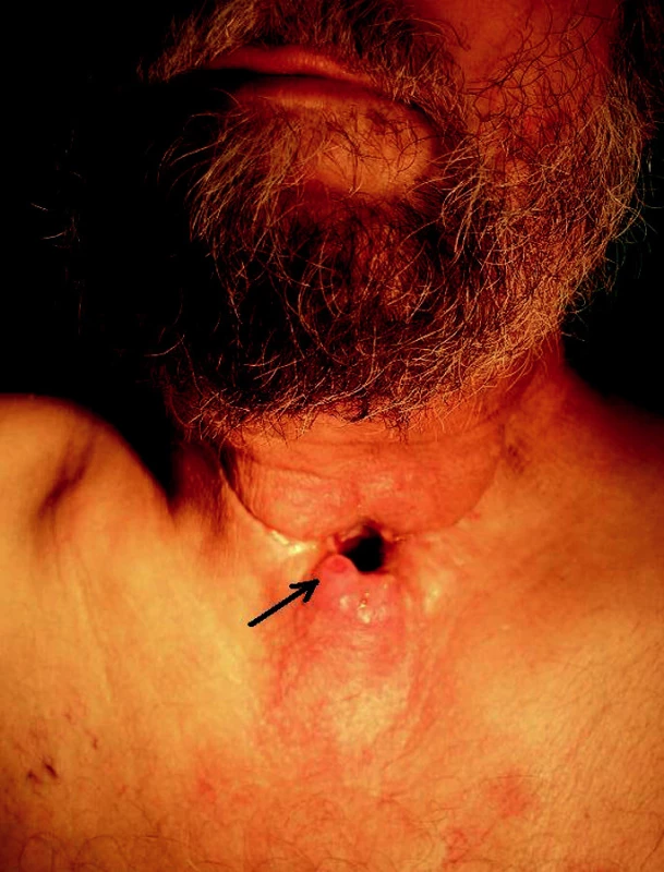 Paratracheostomická rekurence (šipka) u pacienta 9 měsíců po chirurgické léčbě a adjuvantní chemoradioterapii pro laryngofaryngeální spinocelulární karcinom.