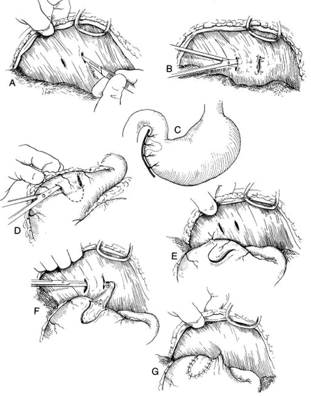 „Belt loop“ gastropexe
Fig. 19: “Belt loop“ gastropexy